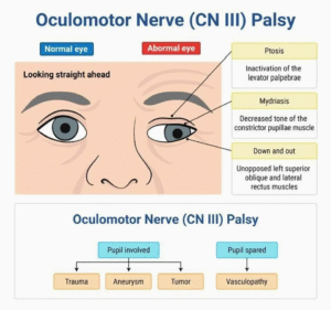 Oculomotor Nerve (CN III) Palsy notes